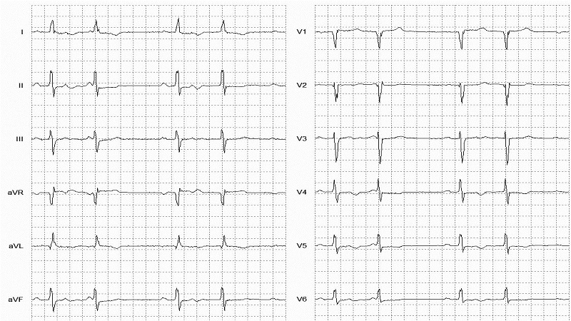 SVEB Patterns (Bigeminy) 12 Lead EKG
